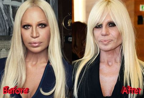 donatella versace venezia 2017|donatella versace before and after surgery.